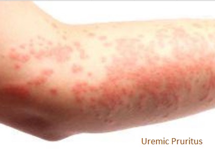 Skin, uremic pruritus - aHUS Alliance ActionaHUS Alliance Action